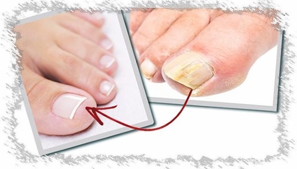 Instrucciones de uso del barniz Oflomil. Precio del esmalte de uñas
