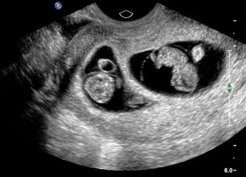 Ultrazvuk blizanaca