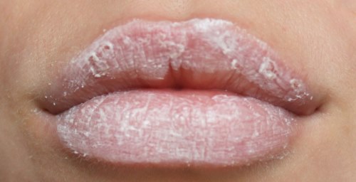 Les coins des lèvres craquent. Pourquoi craquent-ils, se décollent-ils, sèchent-ils. Causes et traitement