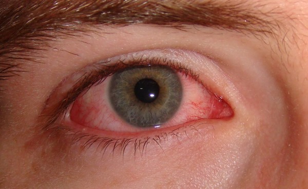 Alergija na ekstenzije trepavica. Simptomi, što učiniti kako se ne bi uklonili, posljedice, kapi