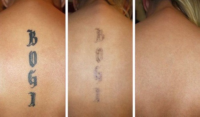 Wie man ein Tattoo mit einem Laser entfernt, Rezepte zu Hause ohne Narben. Vor und nach Fotos