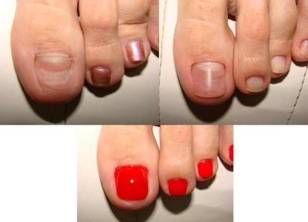 Produljenje noktiju na nogama gelom, poligelom. Prije i poslije fotografija, kako to učiniti