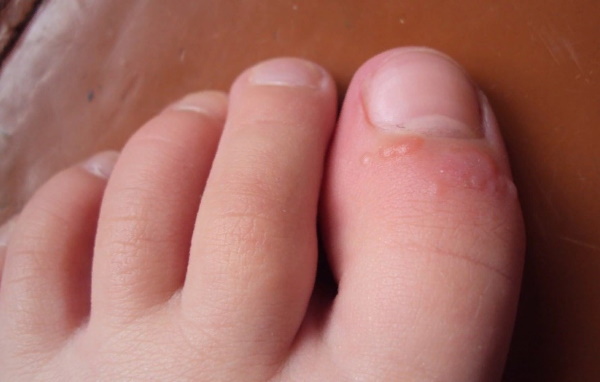 Produljenje noktiju na nogama gelom, poligelom. Prije i poslije fotografija, kako to učiniti