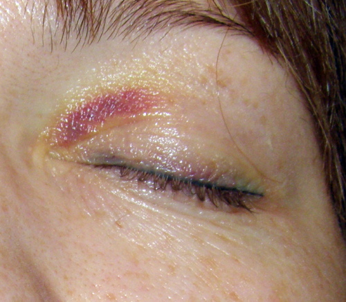 Pembuangan tatu mata laser dari kelopak mata. Sebelum dan selepas gambar, akibatnya