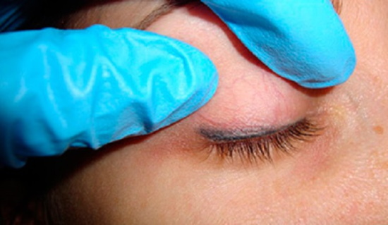 Pembuangan tatu mata laser dari kelopak mata. Sebelum dan selepas gambar, akibatnya