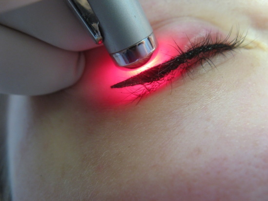 Silmätatuoinnin laserpoisto silmäluomista. Ennen ja jälkeen valokuvia, seuraukset