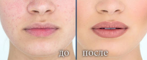Fordyce Granulat und permanentes Lippen Make-up. Vor und nach Fotos, Bewertungen